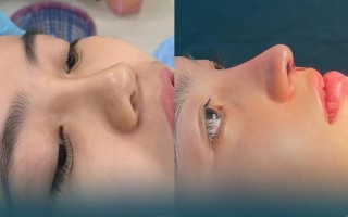Hành trình từ Cam Ranh đến Sài Gòn: Hai chị em và cuộc lột xác với nâng mũi phong thủy tại Minhon