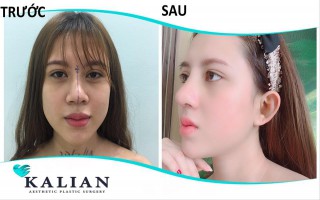 Hiểu đúng về phương pháp nâng ngực chảy xệ từ góc nhìn chuyên gia